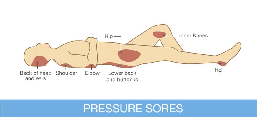 bedsores area on human body part.