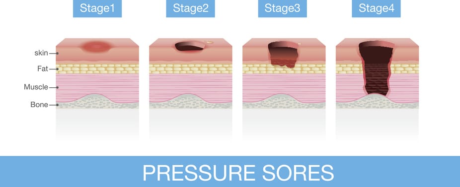 Stages of Pressure Sores of patient skin which extends from skin into muscles and bone. This is medical illustration.