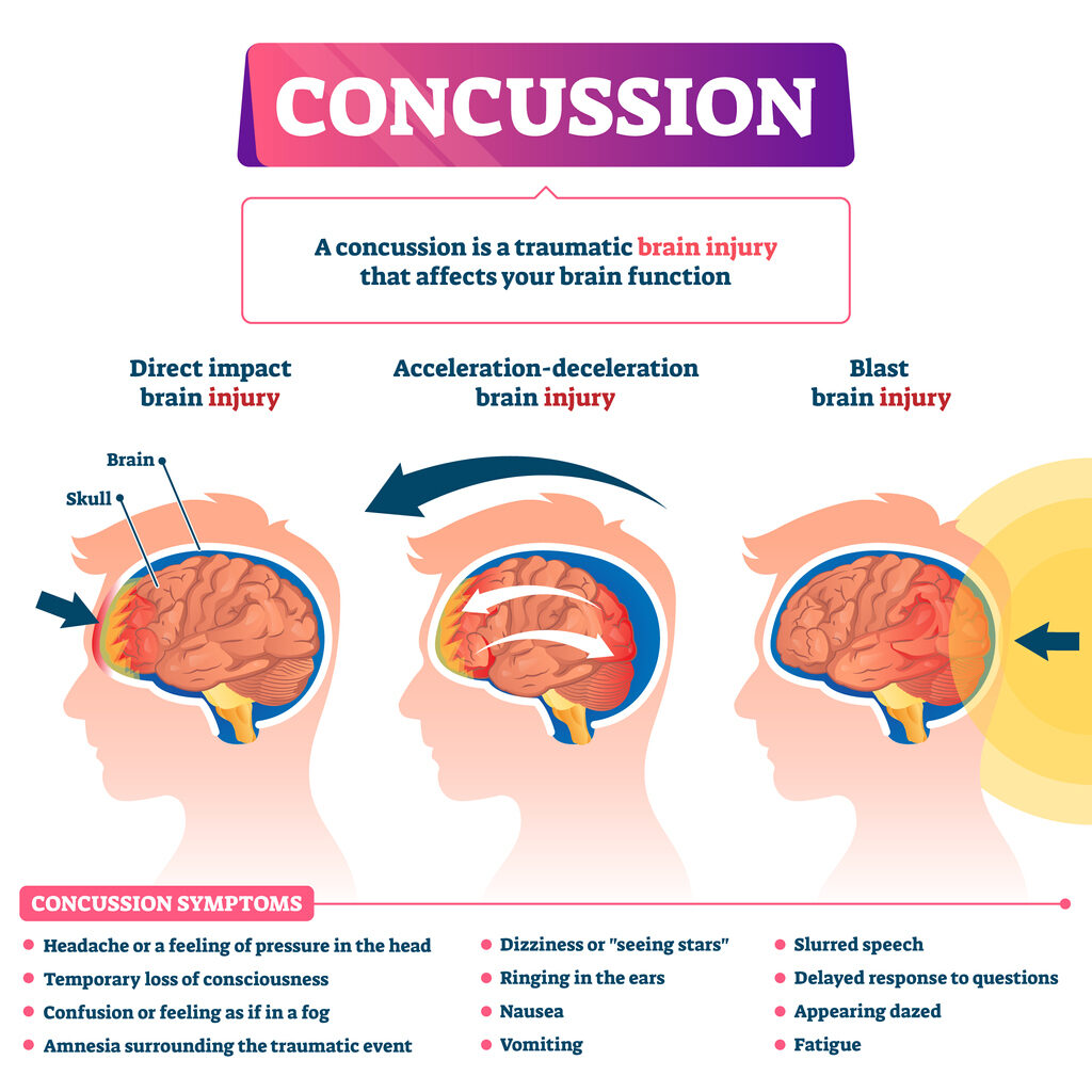 Concussion vector illustration. Labeled educational post head trauma scheme. Medical explanation with brain injury kinds. Direct impact, acceleration and blast health causes with symptoms list diagram